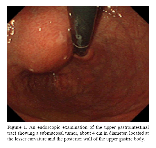 pancreas-showing-submucosal-tumor