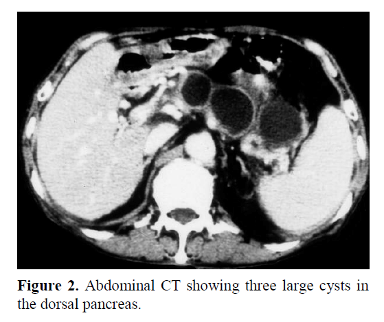 pancreas-showing-three-large-cysts