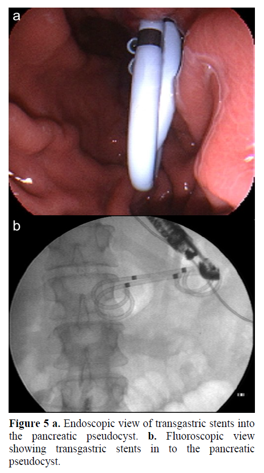 pancreas-showing-transgastric-stents