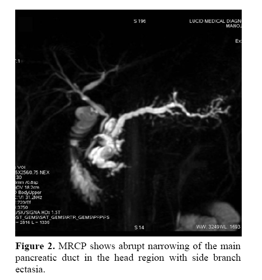 pancreas-shows-abrupt-narrowing