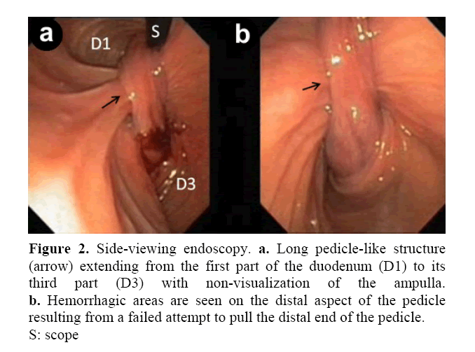 pancreas-side-viewing-endoscopy