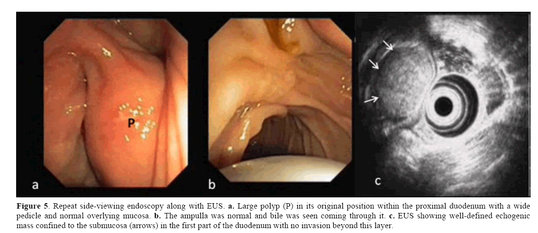 pancreas-side-viewing-endoscopy