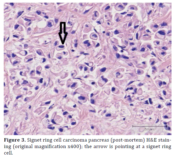 Signet-ring cell carcinoma of the ampulla of Vater: a case diagnosed via  repeated biopsies | Clinical Journal of Gastroenterology