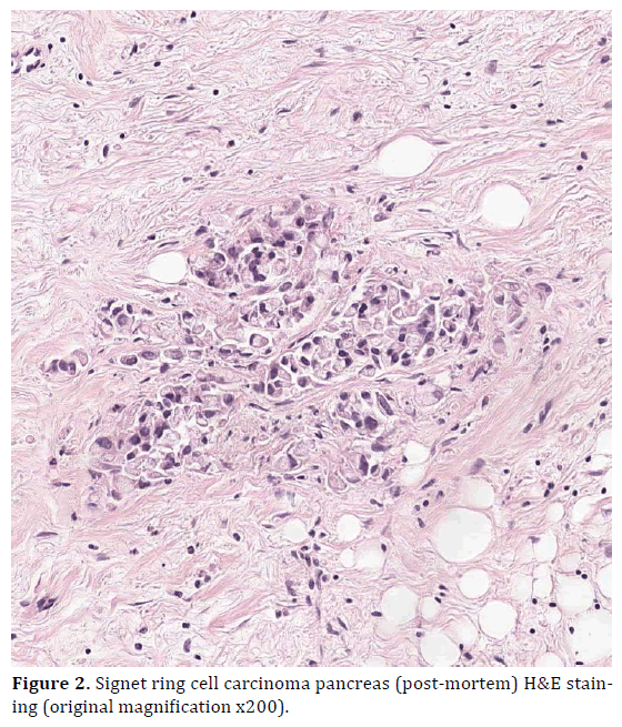 pancreas-signet-ring-carcinoma-pancreas