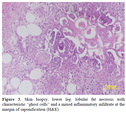 pancreas-skin-biopsy-lower-leg