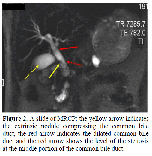 pancreas-slide-mrcp-extrinsic-nodule