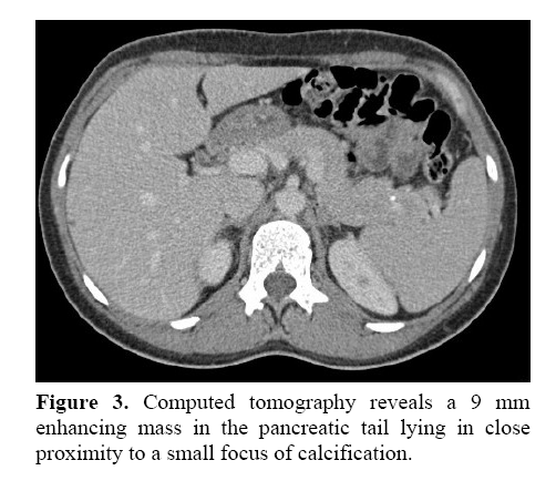 pancreas-small-focus-calcification