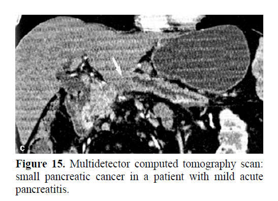 pancreas-small-pancreatic-cancer