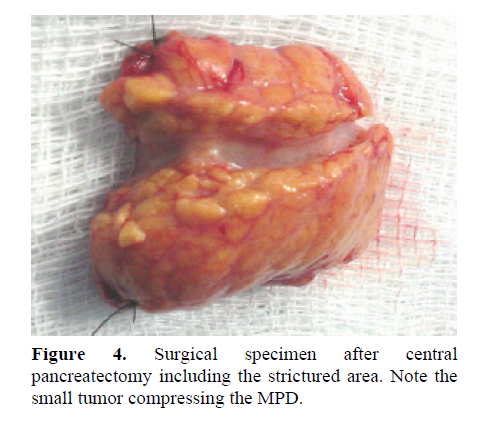 pancreas-small-tumor-compressing