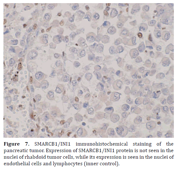 pancreas-smarcb1-immunohistochemical