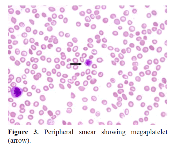 pancreas-smear-showing-megaplatelet