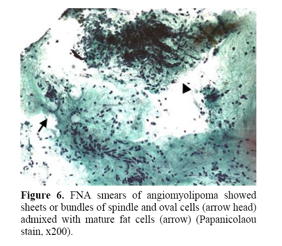 pancreas-smears-angiomyolipoma