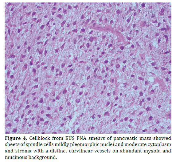 pancreas-smears-pancreatic-mass