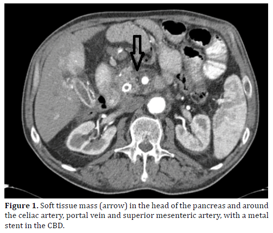 pancreas-soft-tissue-mass-head-pancreas