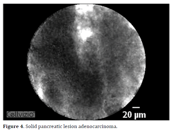 pancreas-solid-adenocarcinoma