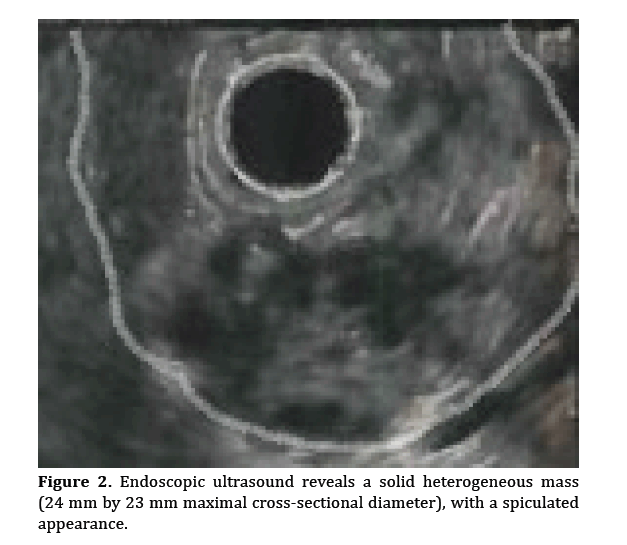 pancreas-solid-heterogeneous-mass