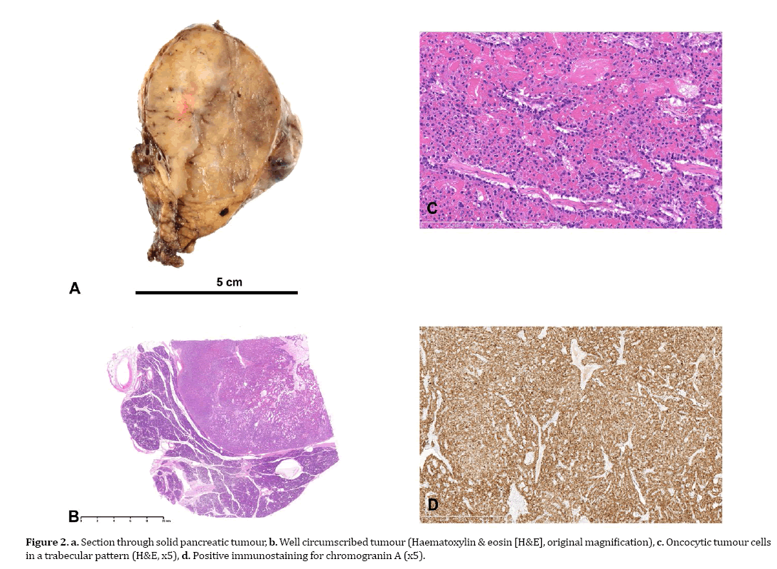 pancreas-solid-pancreatic-tumour