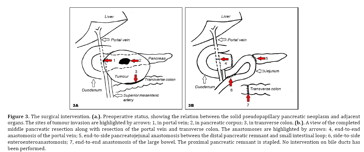 pancreas-solid-pseudopapillary-pancreatic
