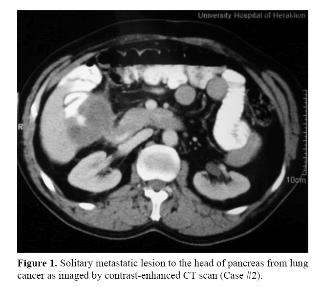pancreas-solitary-metastatic-lesion