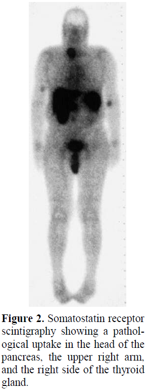 pancreas-somatostatin-receptor-scintigraphy