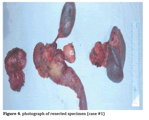pancreas-specimen