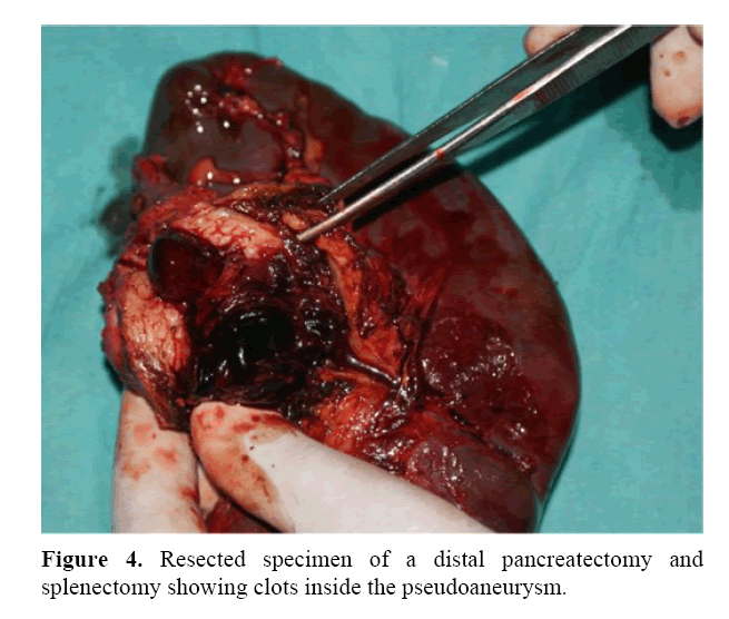 pancreas-specimen-distal-pancreatectomy