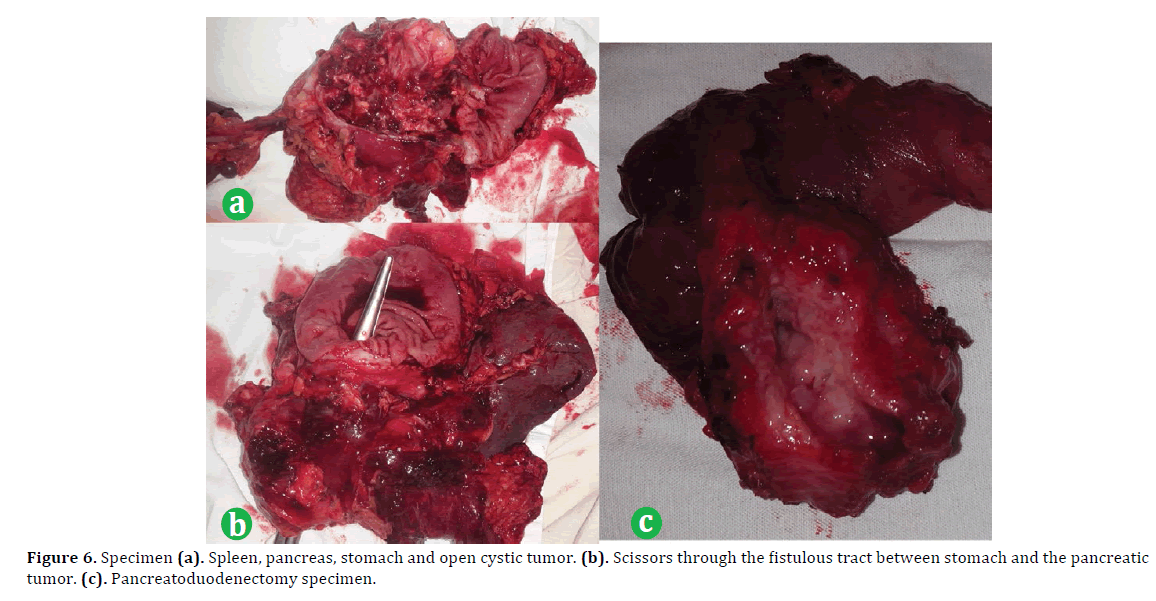 pancreas-specimen-spleen-pancreas