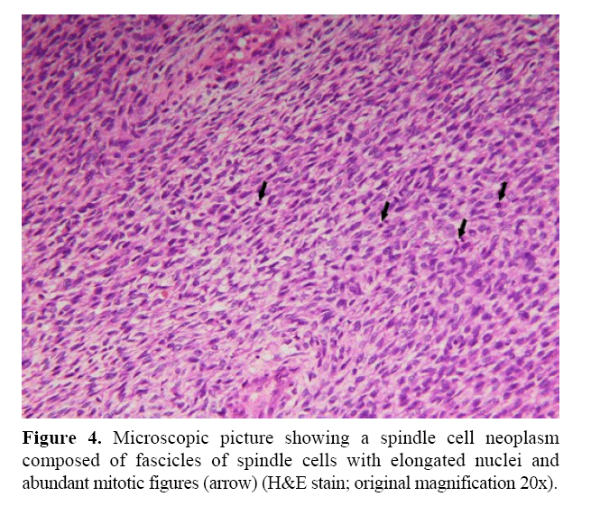 pancreas-spindle-cell-neoplasm