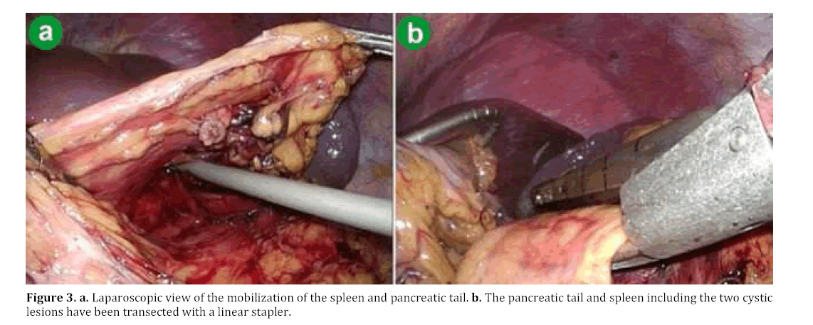 pancreas-spleen-pancreatic-tail