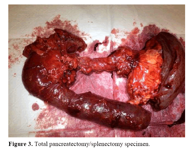 pancreas-splenectomy-specimen