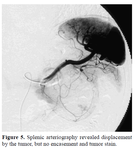 pancreas-splenic-arteriography-encasement