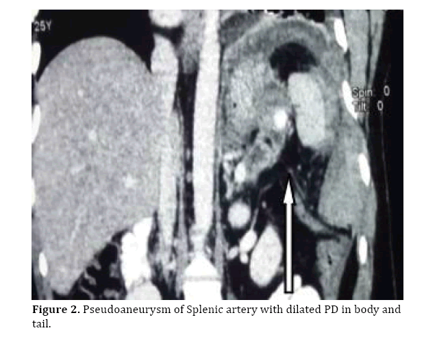 pancreas-splenic-artery