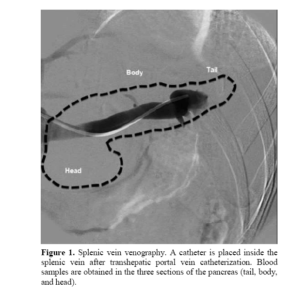 pancreas-splenic-vein-venography