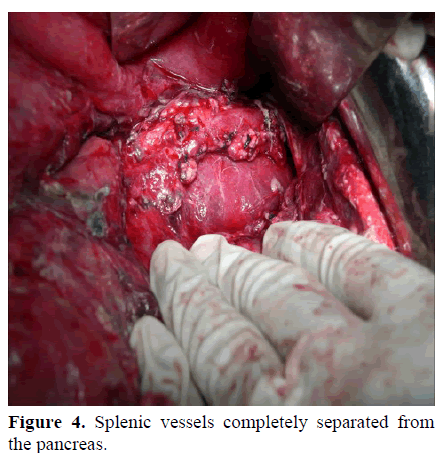 pancreas-splenic-vessels-pancreas