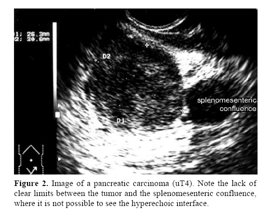 pancreas-splenomesenteric-confluence