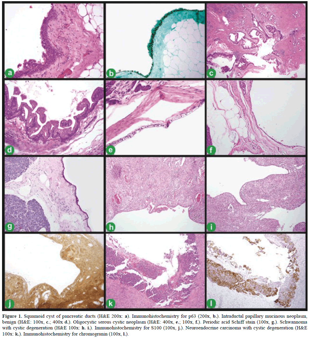 pancreas-squamoid-cyst-pancreatic-ducts