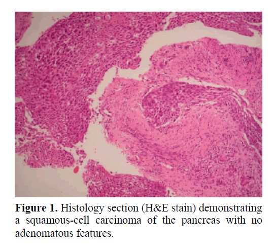pancreas-squamous-cell-carcinoma