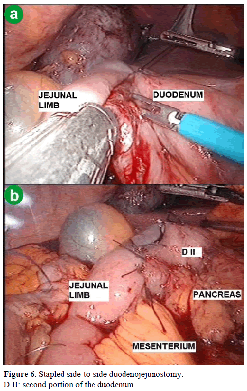pancreas-stapled-duodenojejunostomy