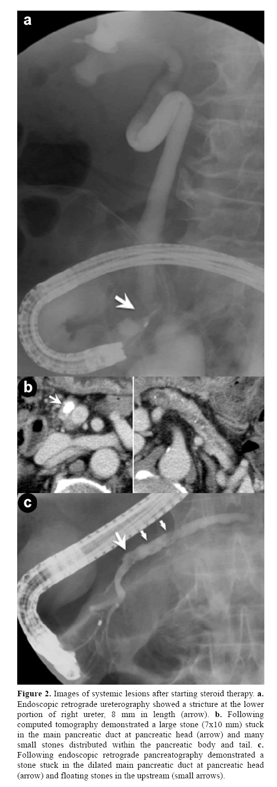 pancreas-starting-steroid-therapy