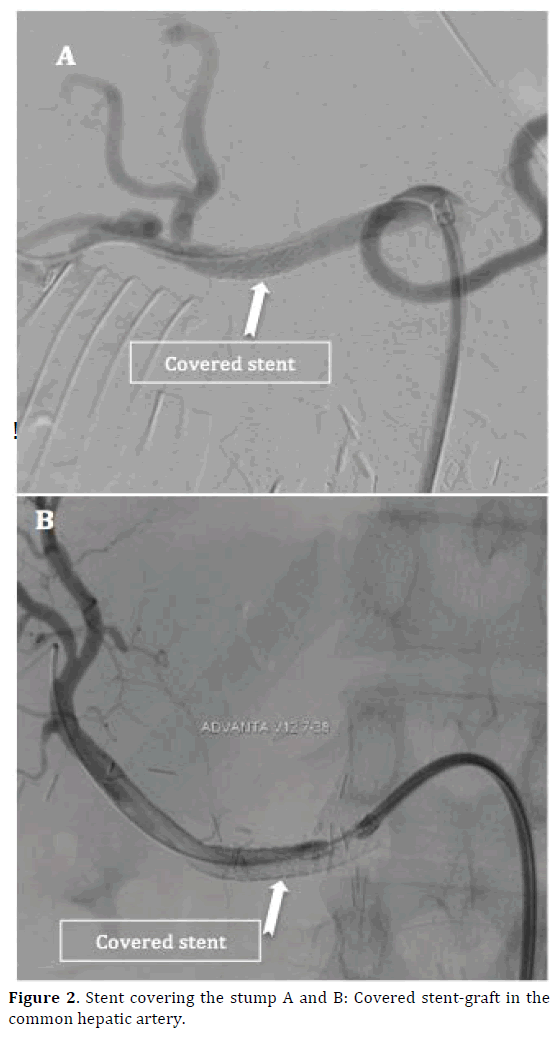 pancreas-stent-hepatic-artery