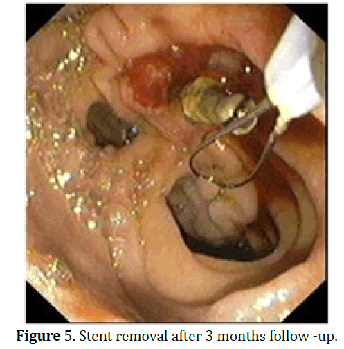 pancreas-stent-removal-3-months-follow