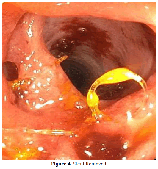 pancreas-stent-removed