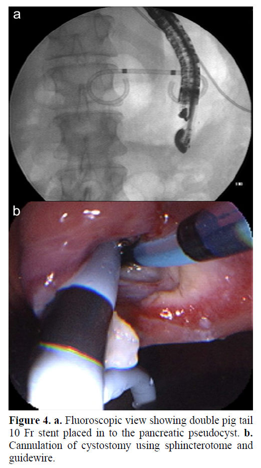 pancreas-stents-pancreatic-pseudocyst