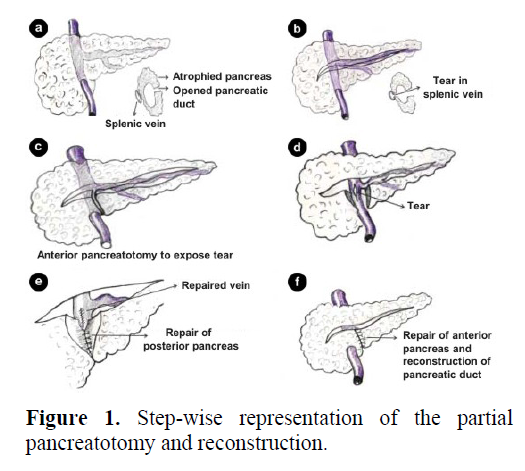 pancreas-step-wise-representation