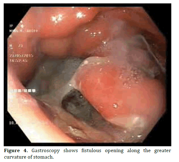 pancreas-stomach