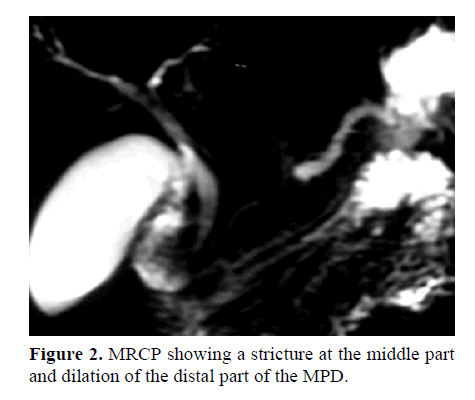 pancreas-stricture-middle-part