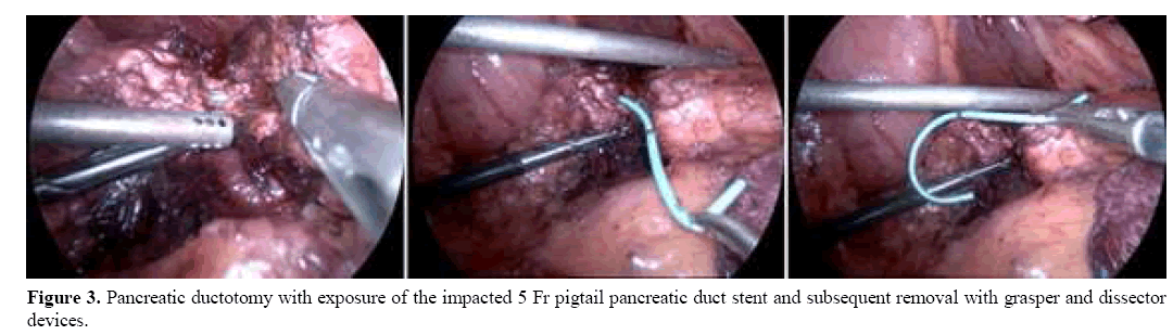 pancreas-subsequent-removal-grasper