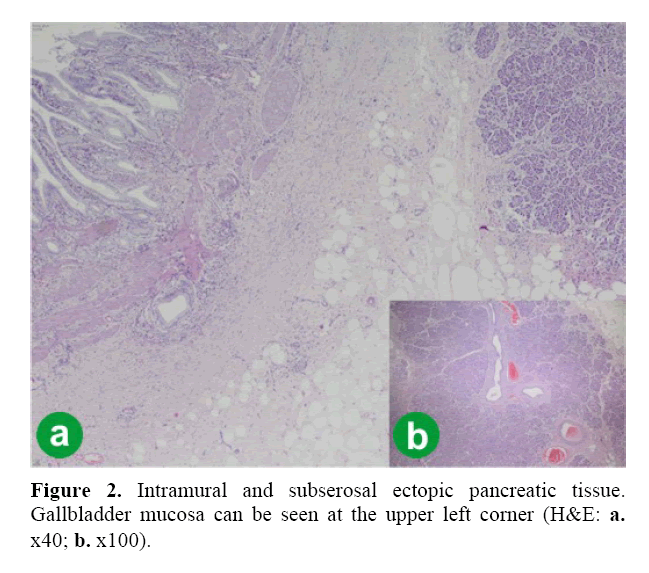 pancreas-subserosal-ectopic-pancreatic