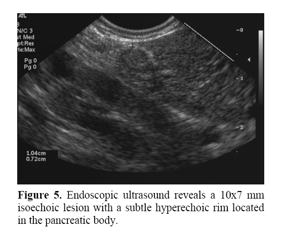 pancreas-subtle-hyperechoic-rim