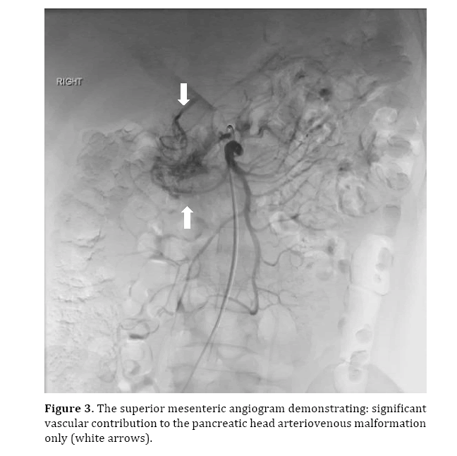 pancreas-superior-mesenteric-angiogram